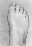 Accessory Navicular Syndrome